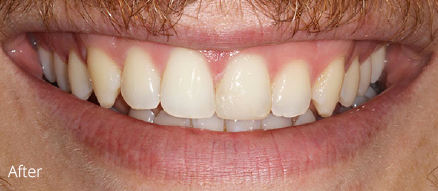 A close up of a man 's mouth with white teeth and a beard.