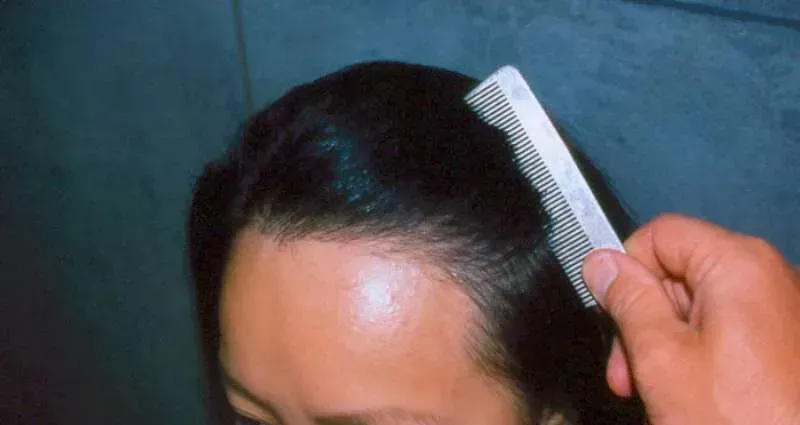 After hair transplant