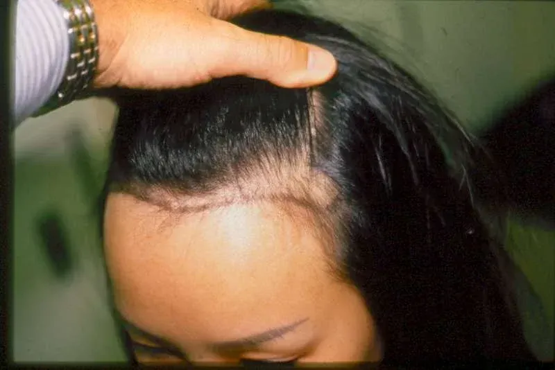 Before hair transplant