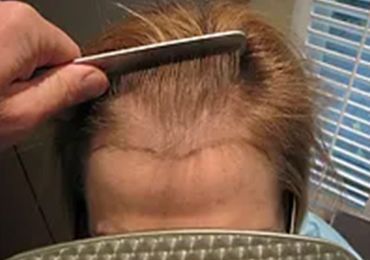 FEMALE HAIR TRANSPLANT