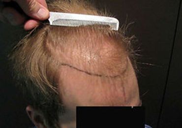MALE HAIR TRANSPLANT