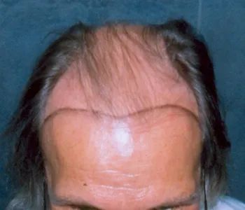 TRANSGENDER HAIR TRANSPLANT