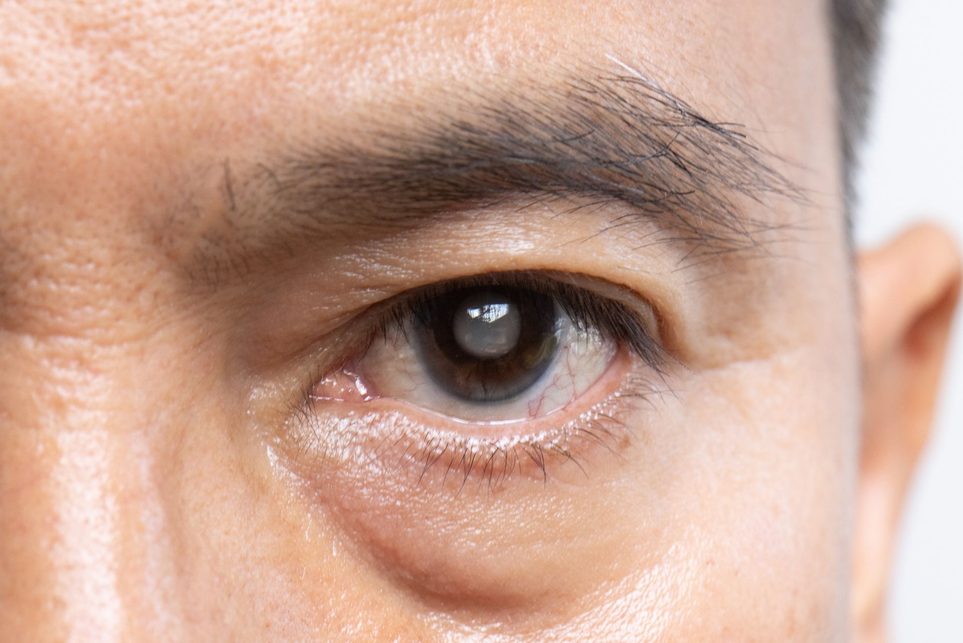 A close-up of a man's eye with a cataract.