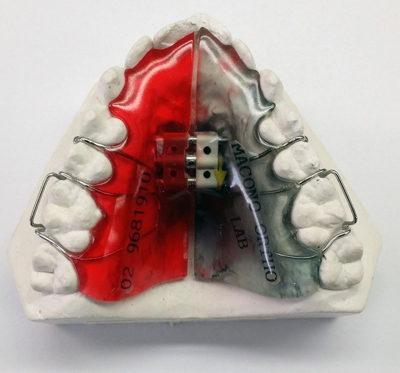 Orthodontic Appliances Sydney, NSW Macono Orthodontic & Dental