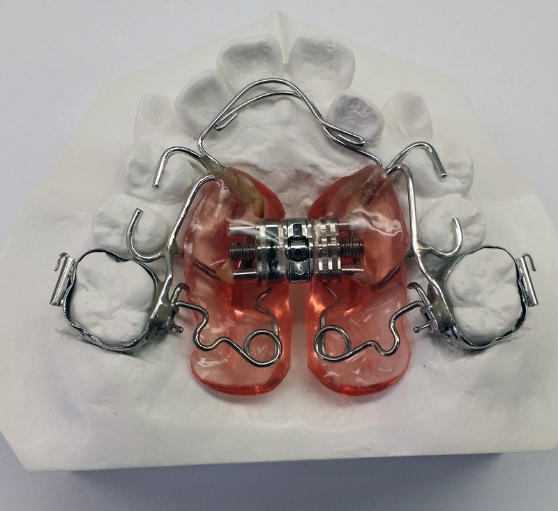 Orthodontic Appliances Sydney, NSW Macono Orthodontic & Dental