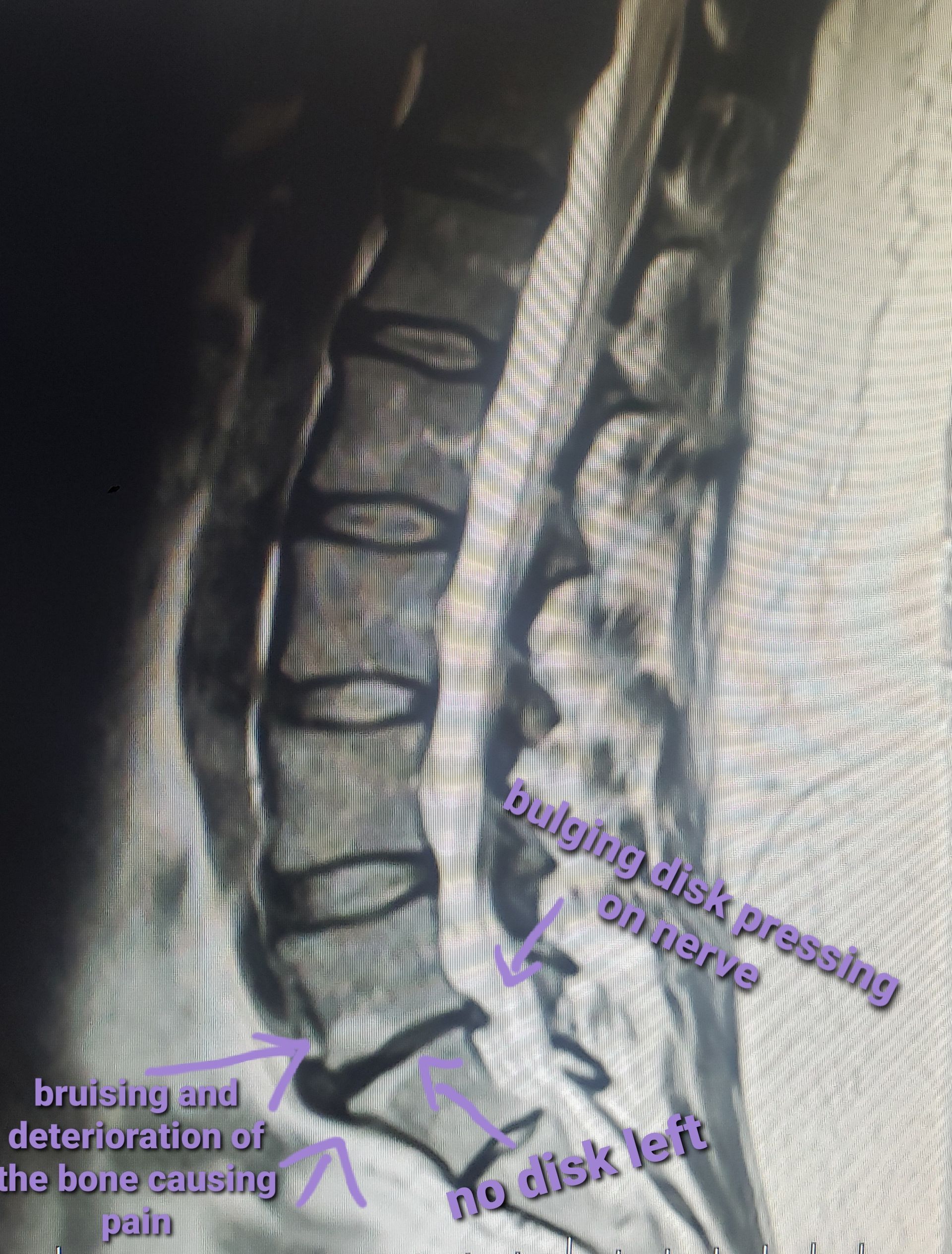 Alex back x-ray image of injury