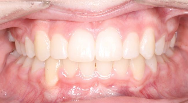 Close-up of a person's mouth showing upper and lower front teeth and pink gums, with one yellowish tooth.
