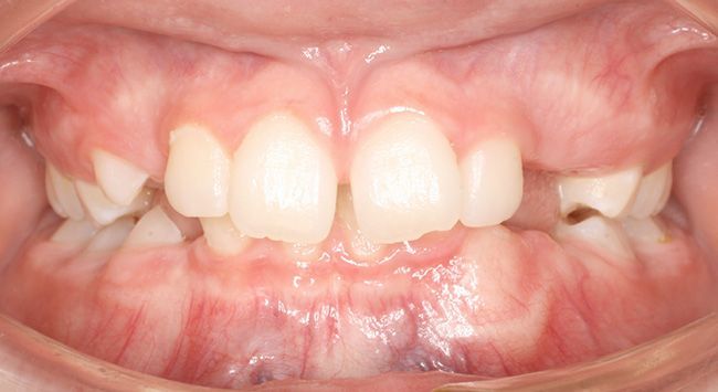 Close-up of a child's mouth showing crooked front teeth and pink gums