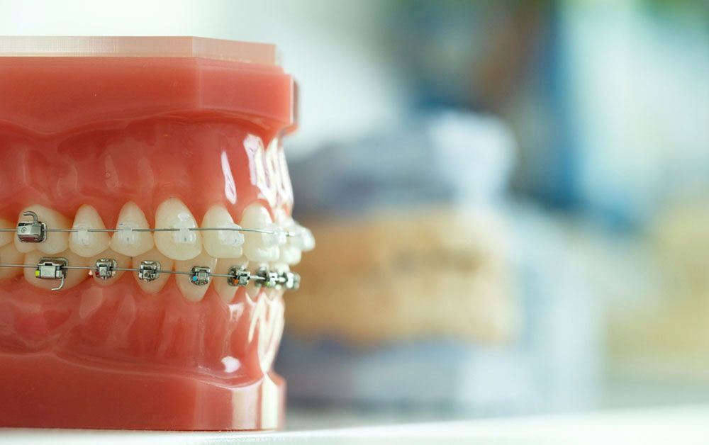Dental model with metal braces on teeth, side view against a blurred background