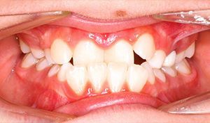 Close-up of a child’s mouth with crowded, misaligned front teeth and a gap between teeth
