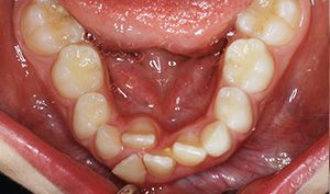 Close-up of lower teeth and gums inside an open mouth, showing a central lower tooth gap.