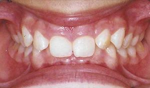 Close-up of a child's mouth showing spaced front teeth and pink gums