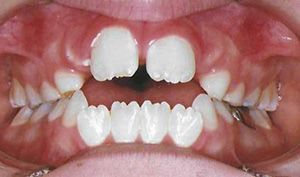Close-up of a mouth with spaced front teeth and visible gums, showing teeth development unevenly