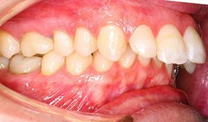 Close-up of teeth and gums showing dental misalignment and a side bite view