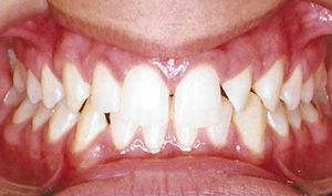 Close-up of teeth showing crowded, misaligned front teeth and a gap between the upper incisors