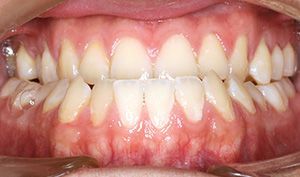 Close-up of human teeth with visible gum recession and redness around the upper and lower gums