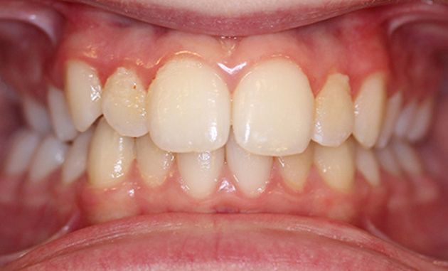 Close-up of human teeth and gums with noticeable crowding and misalignment.