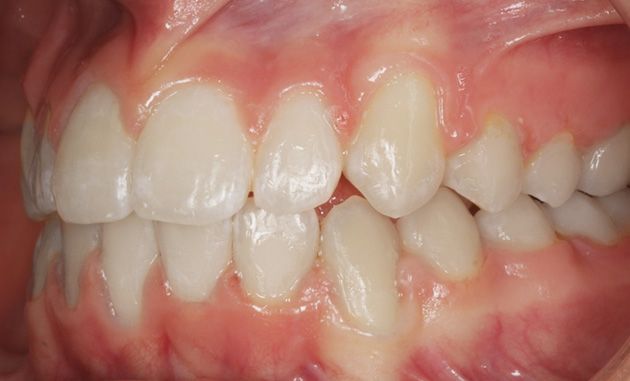 Close-up of teeth and gums in a side bite, showing crowded front teeth and a slight overbite