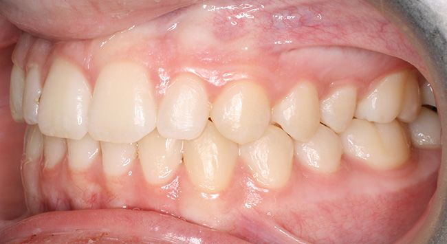 Close-up of teeth with dental retractor, showing crowded upper and lower teeth and gums