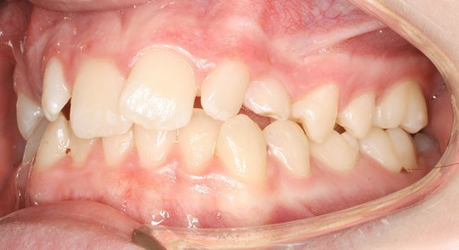 Close-up of a mouth showing teeth with visible crowding and misalignment