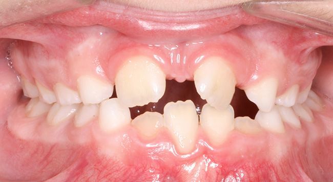 Close-up of a child's open mouth showing crowded baby teeth and a gap in the upper front teeth