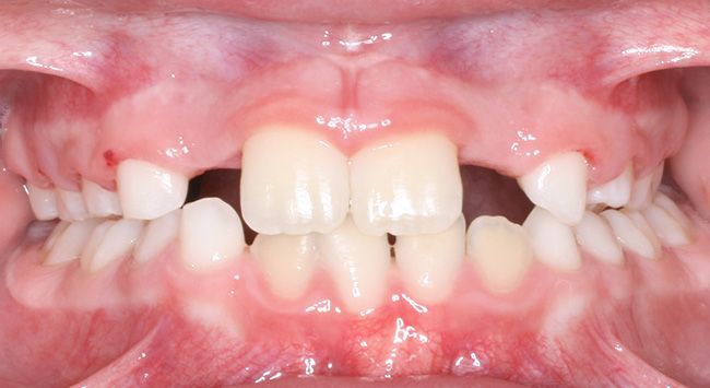 Close-up of a mouth with misaligned teeth and gaps, lips parted against a pink background.