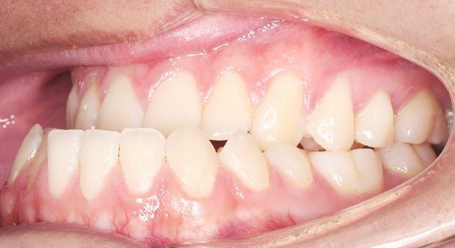 Close-up of a person's teeth and gums, showing a side view of the mouth and bite alignment.