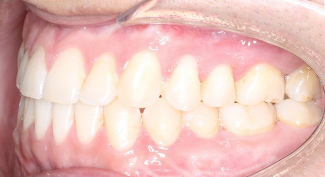 Close-up of a mouth showing teeth and gums in a side smile.