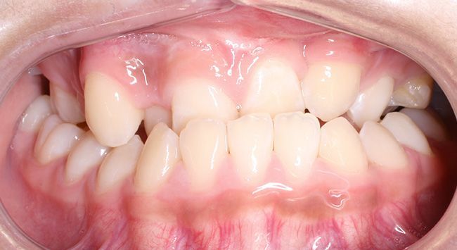 Close-up of a child’s mouth showing upper and lower teeth with slightly misaligned front teeth