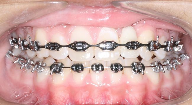 Close-up of teeth with metal braces and colored bands on upper and lower teeth