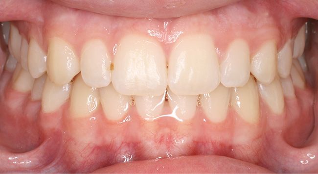 Close-up of a mouth showing teeth and gums in a side smile.