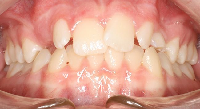 Close-up of a person's teeth and gums, showing a side view of the mouth and bite alignment.
