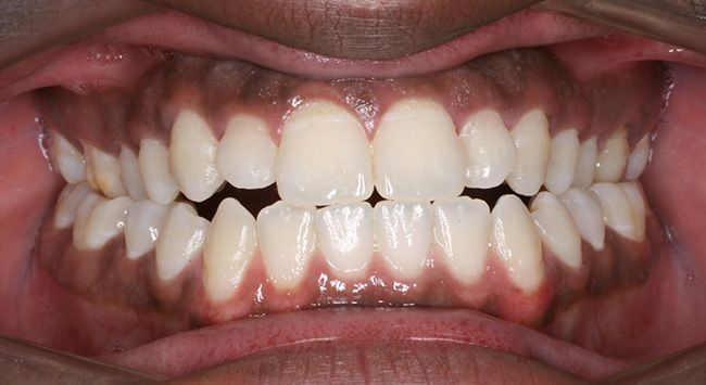 Close-up of a mouth showing teeth with open bite and crowding, lips pulled back