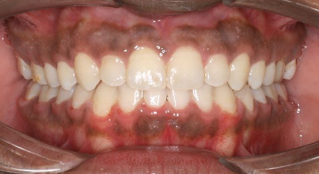 Close-up of a mouth with braces, showing teeth and dark red gums against a pink oral interior