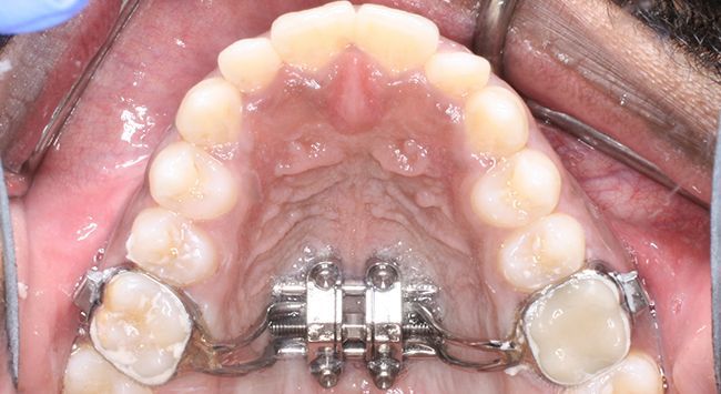 Upper dental arch with braces and molars, showing the palate from an overhead mouth view