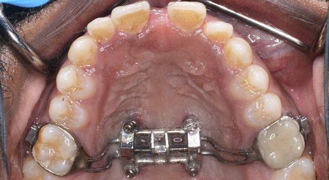 Upper dental arch with orthodontic appliance and palate expander on teeth