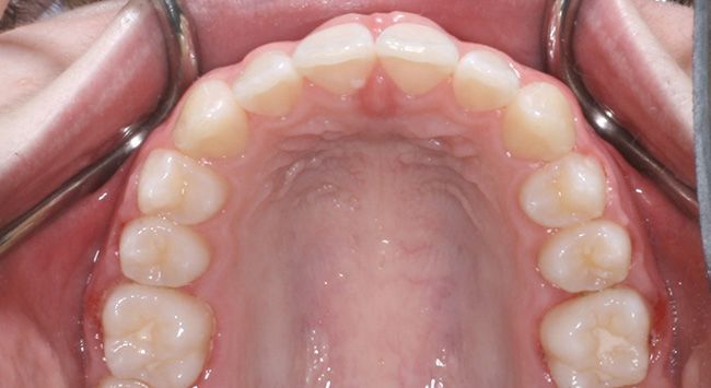 Close-up of teeth with metal braces and colored bands on upper and lower teeth
