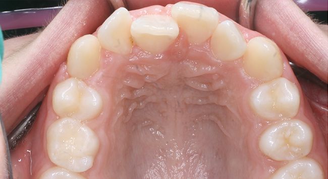 Close-up of a child’s mouth showing upper and lower teeth with slightly misaligned front teeth