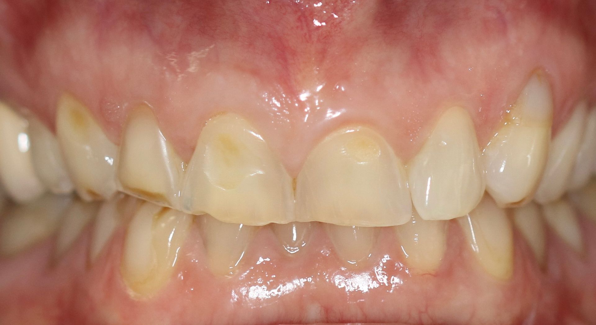 A close up of a person 's teeth with a lot of stains on them.