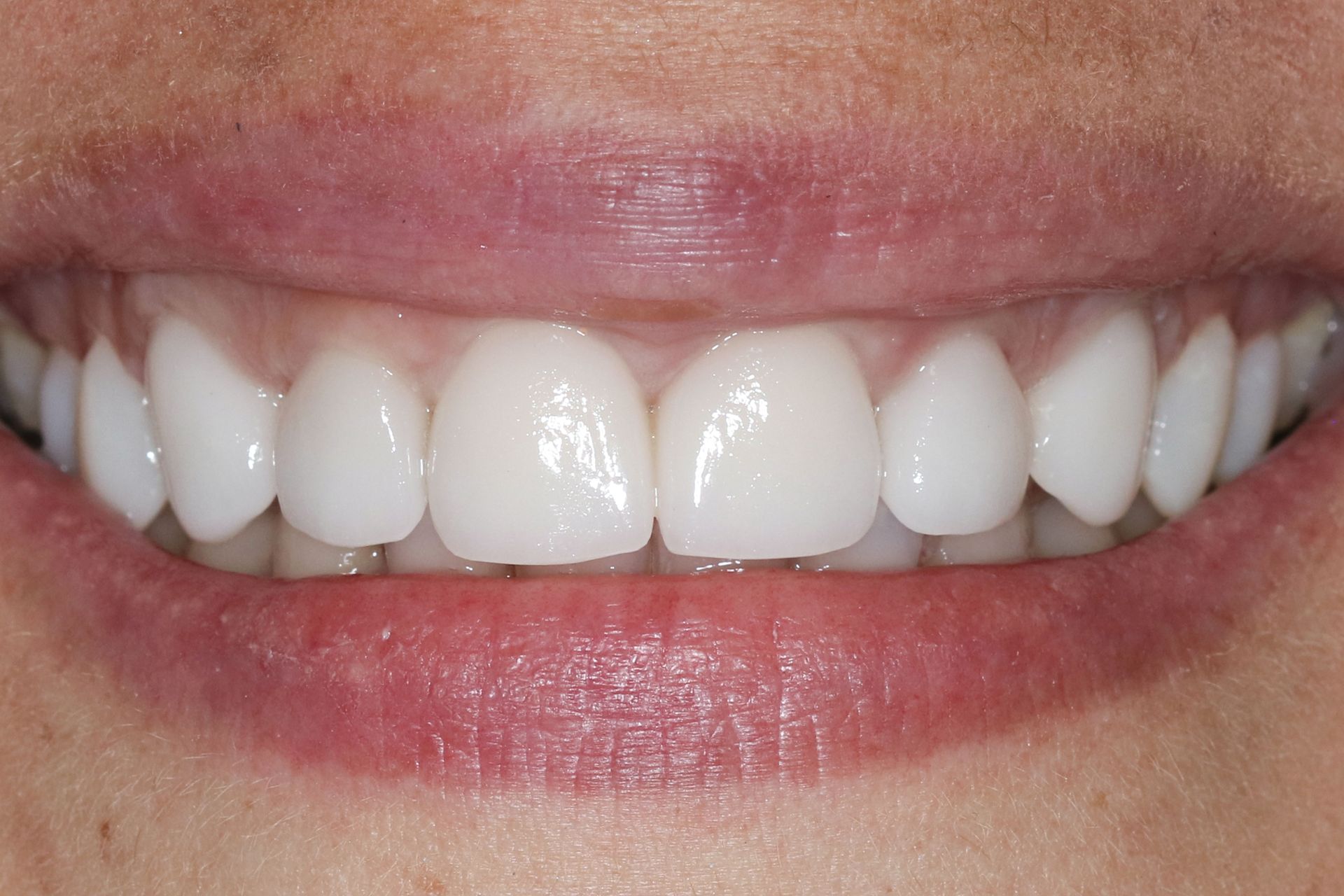 A close up of a person 's mouth with white teeth.
