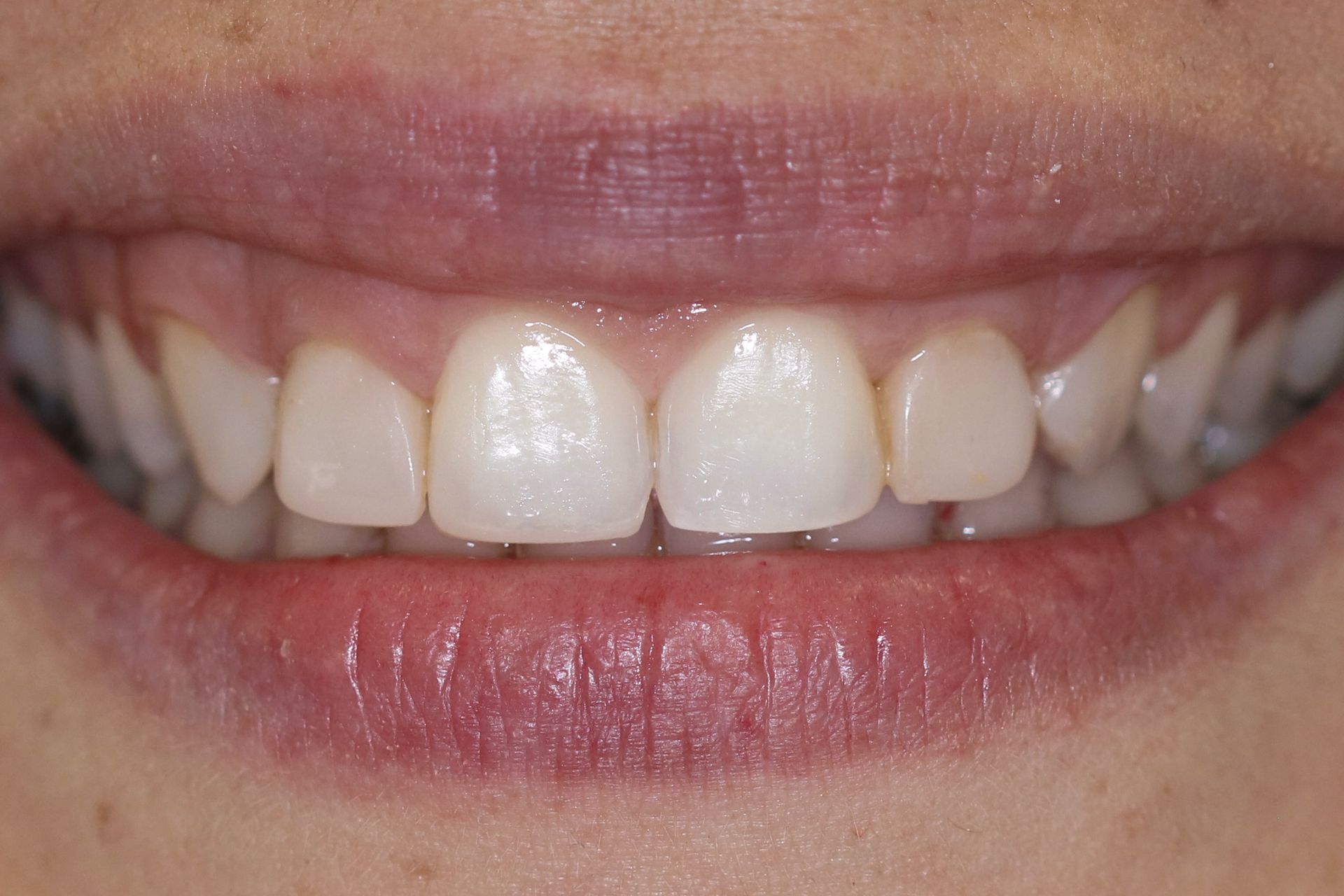 A close up of a person 's teeth with a lot of stains on them.