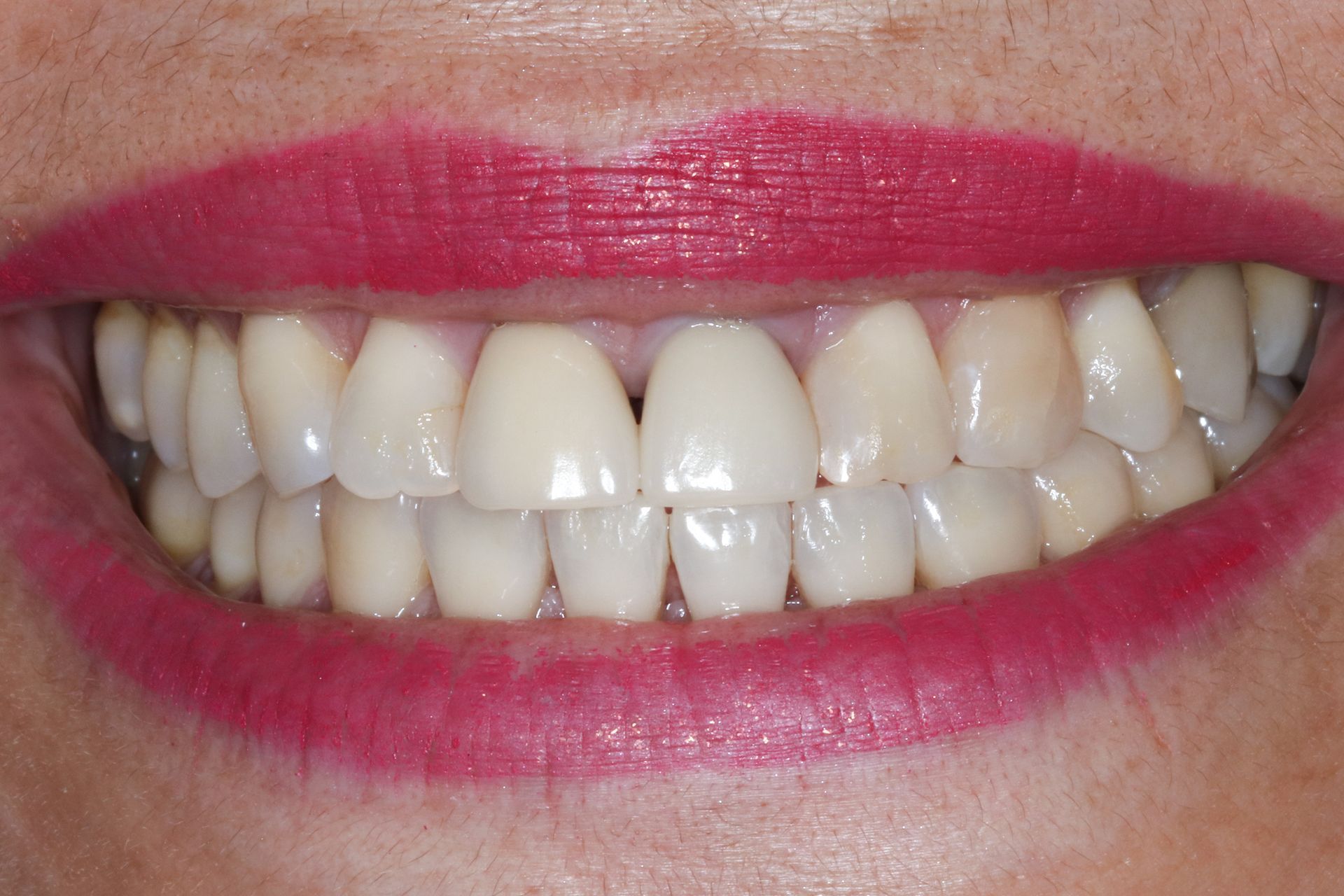A close up of a person 's teeth with a lot of stains on them.