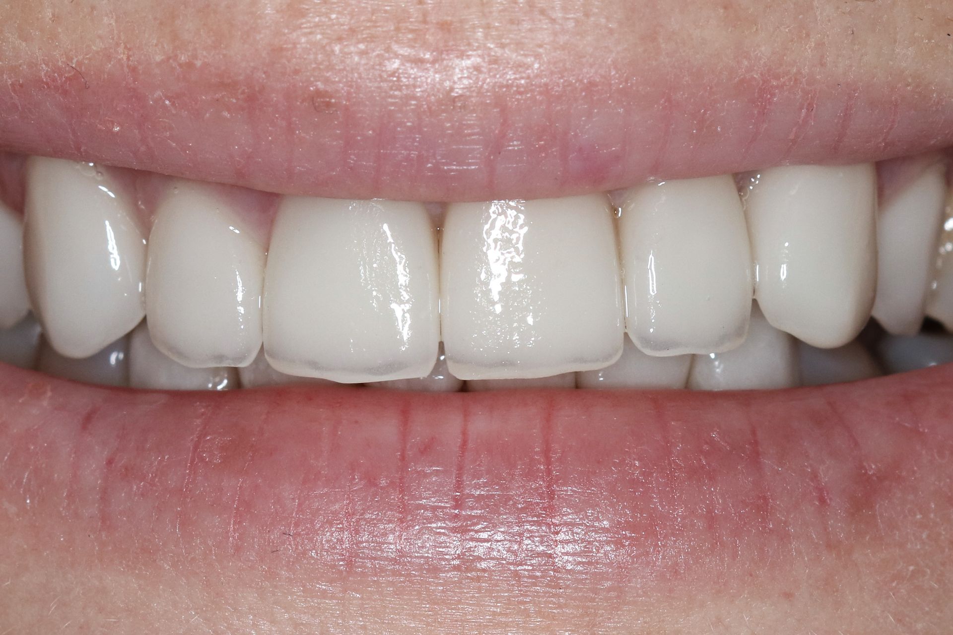 A close up of a person 's mouth with white teeth.