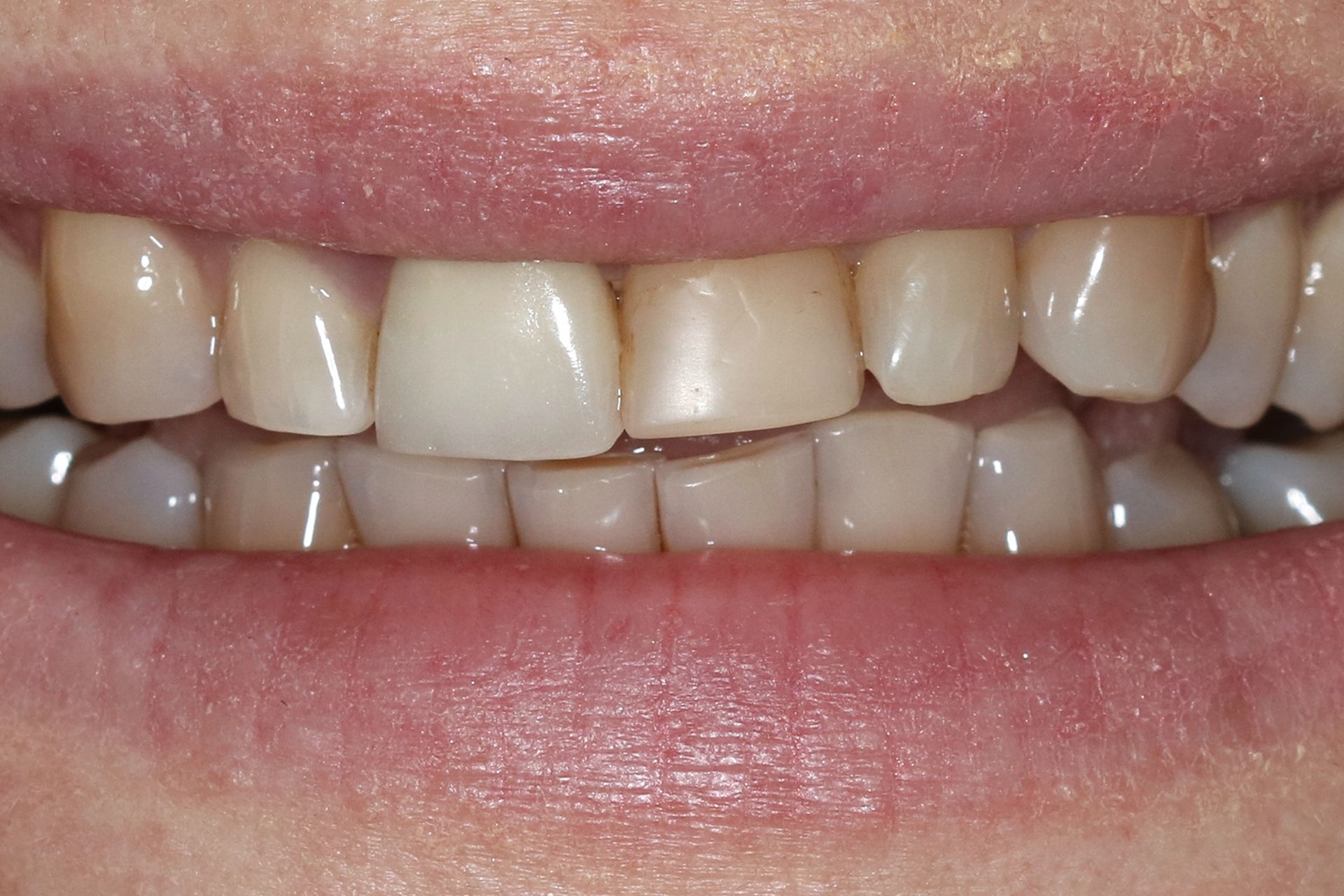 A close up of a person 's teeth with a lot of stains on them.