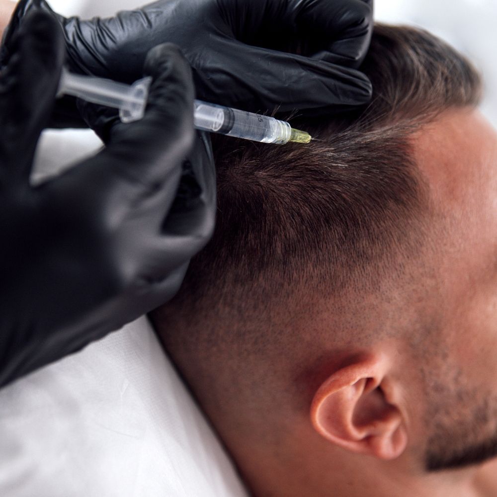 PRP being injected into the scalp along the hairline