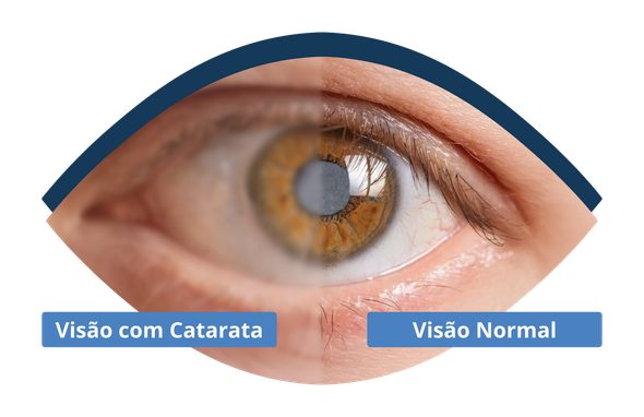 Comparação entre a visão com catarata e a visão normal.