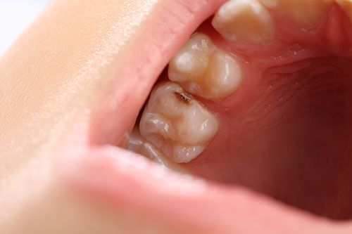 Blanqueamiento, Caries dental, Dentista, Fluoradas