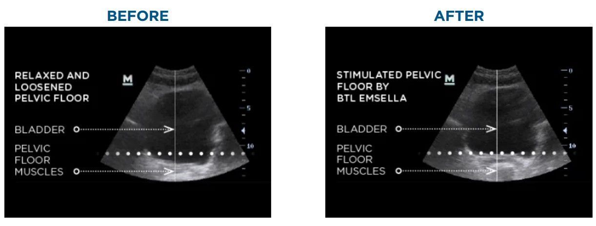 A before and after picture of an ultrasound of a bladder A before and after picture of an ultrasound of a bladder