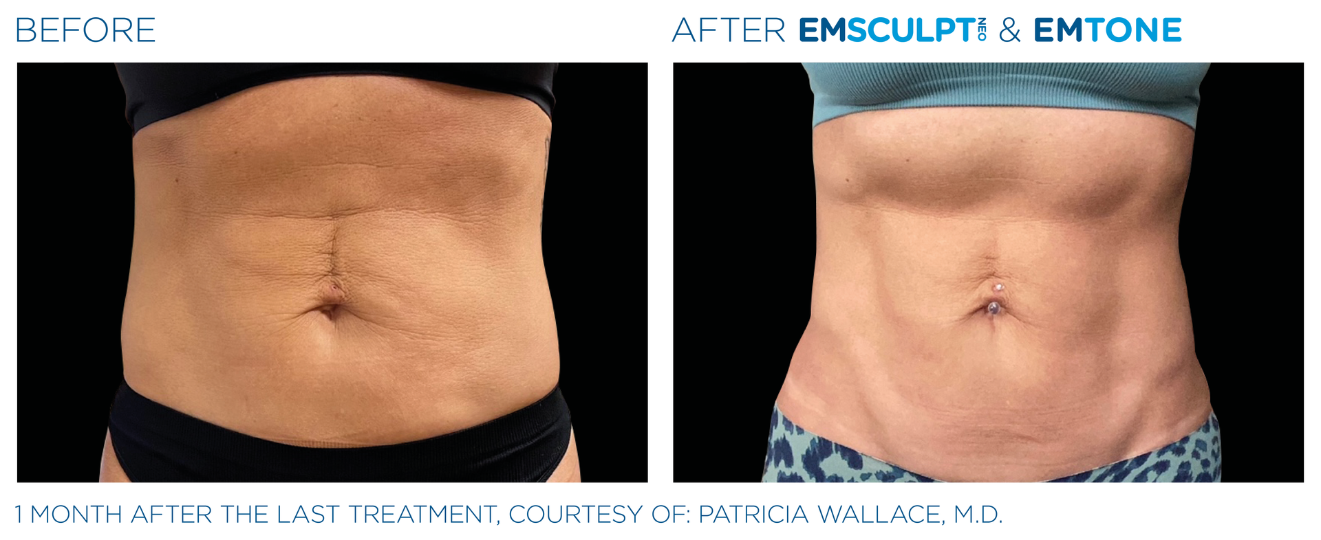 1 month after last treatment of woman's abdomen