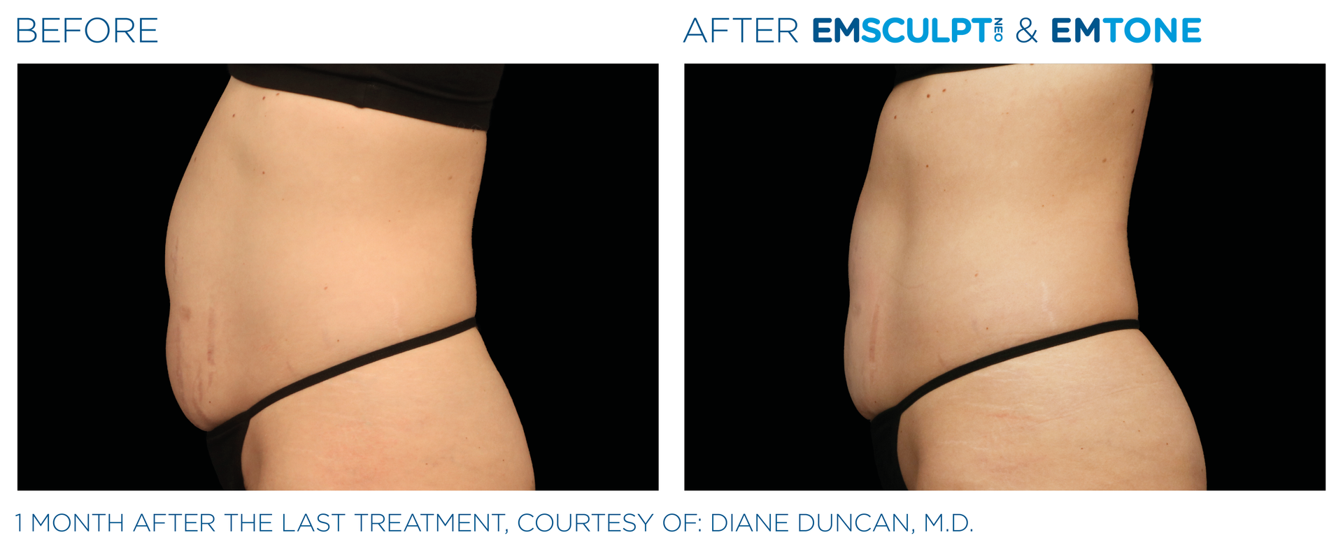1 month after last treatment of woman's stomach